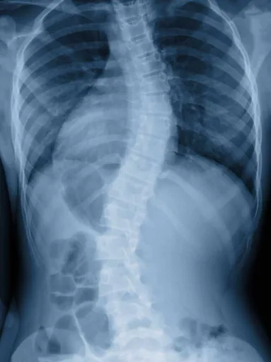 Scoliosis Treatment Fort wayne